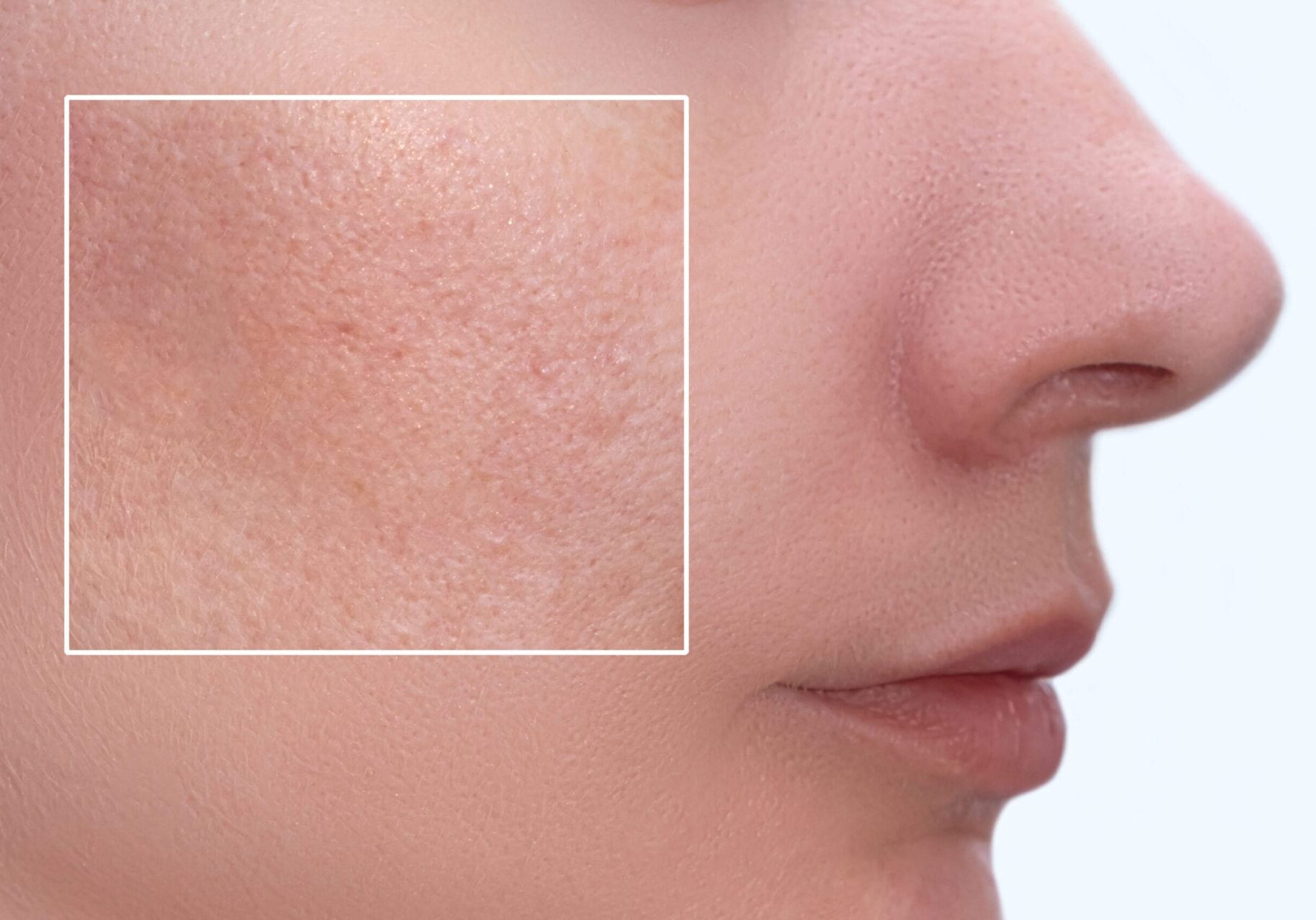 nitric oxide helps prevent clogged pores